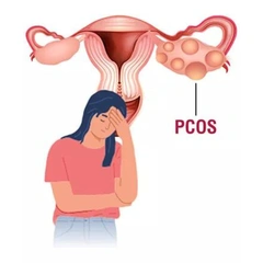 Fibroids, PCOS